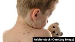 Vaccinarea este singura metodă de protecție contra rujeolei, de aceea specialiștii îndeamnă toți părinții să-și vaccineze copiii. O singură doză de vaccin asigură prevenirea bolii în proporție de 97%. 